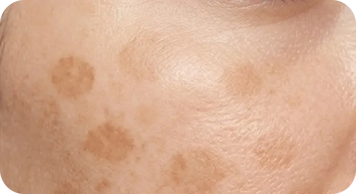 Spots visibly lightening